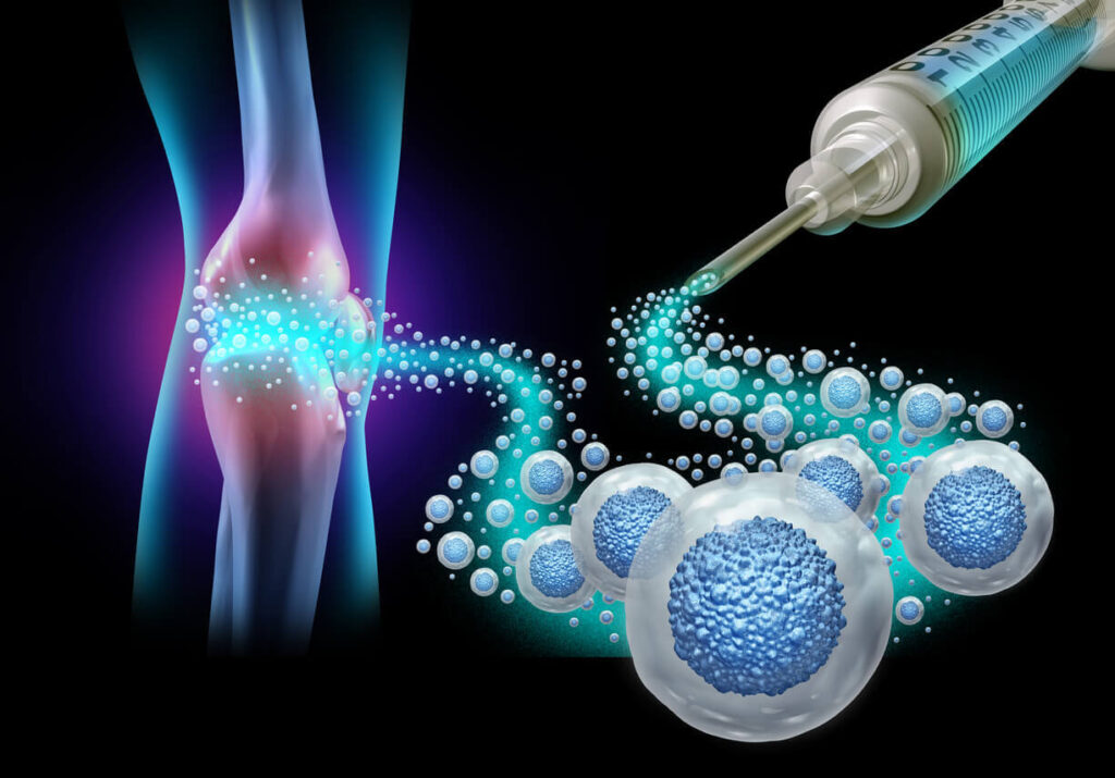 Stem Cell Therapy